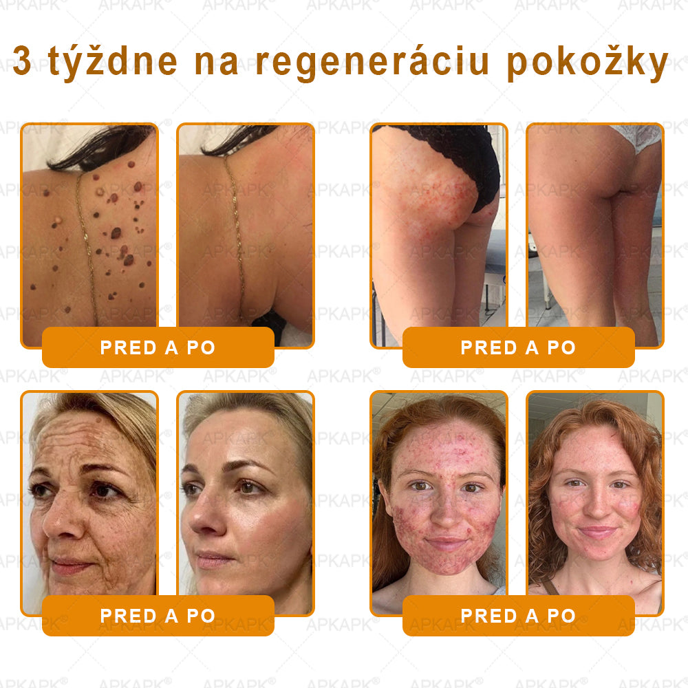 ⏰Zostáva už len 5 balení na sklade! Ponúkame dodatočnú zľavu 50 %! Zdravšie telo je na dosah! Ak to teraz premeškáte, budete musieť na ďalšiu príležitosť počkať až do budúceho roka!⏰𝖠𝖯𝖪𝖠𝖯𝖪®